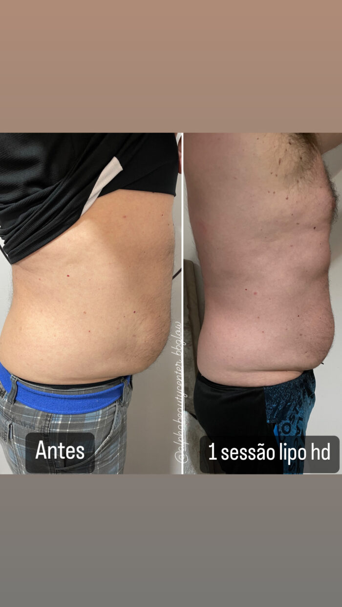 Caneta Pressurizada Elétrica Biomedicalderm - Image 3