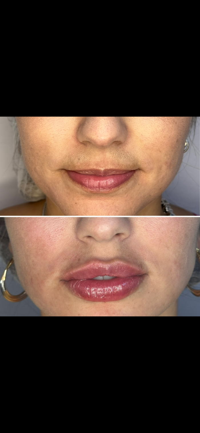 Rennova Lips Plus Preenchedor Labial Ácido hialurônico - Image 2